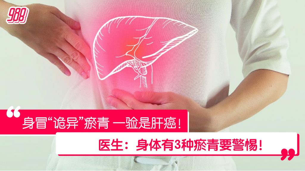 医生：瘀血应在7至10天退掉 身上有3种瘀青恐或是肝癌警讯！ – 988