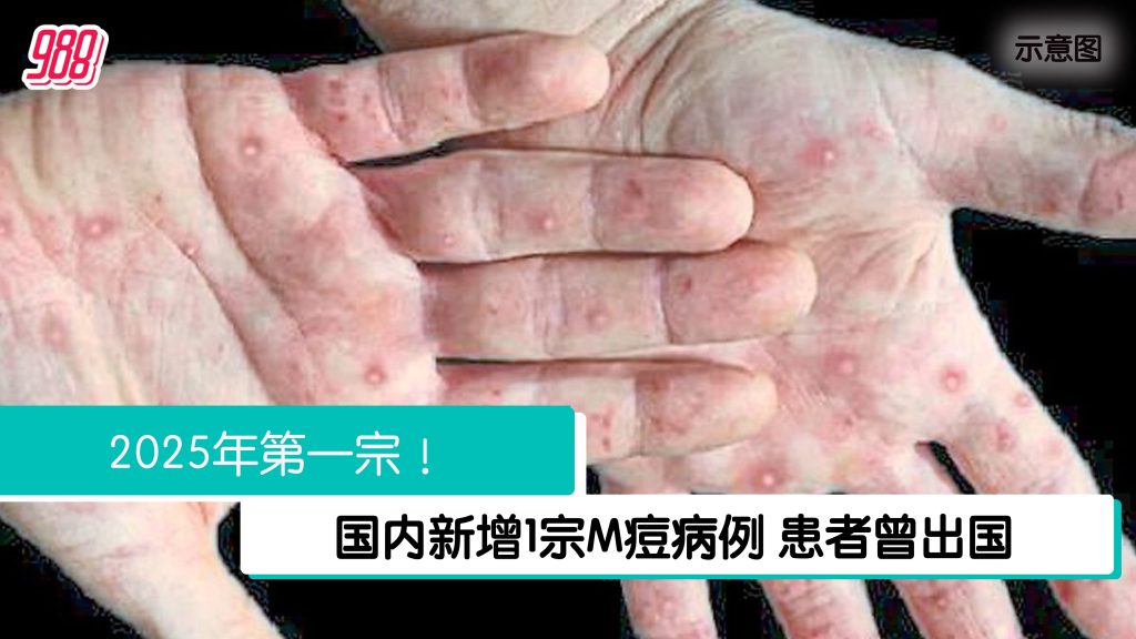 卫生部通报 大马新增一宗M痘病例 – 988